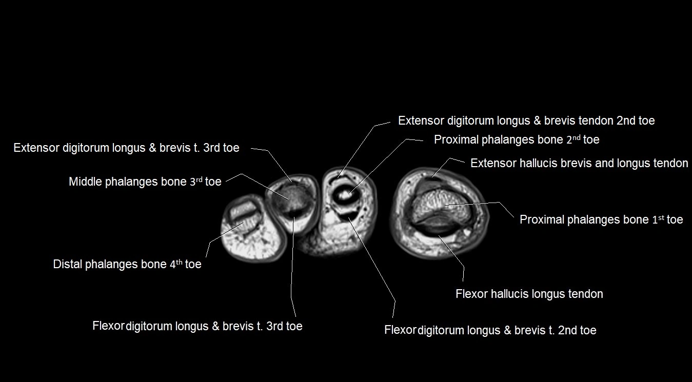 MRI 3T foot axial cross sectional anatomy image 36.webp